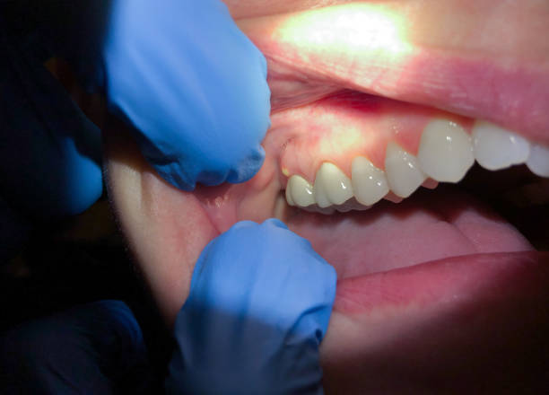 Best Emergency Tooth Extraction in Freeland, MI